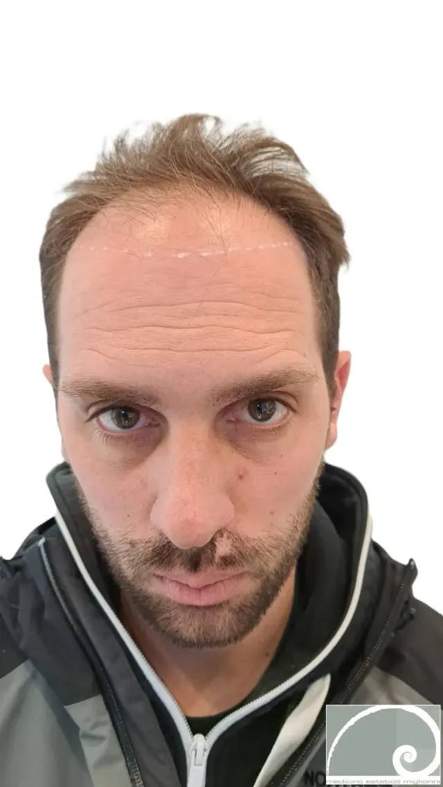 Prima del trattamento