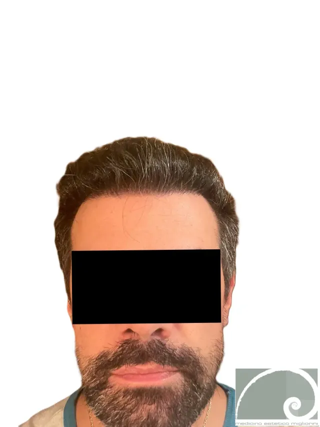 Dopo il trattamento